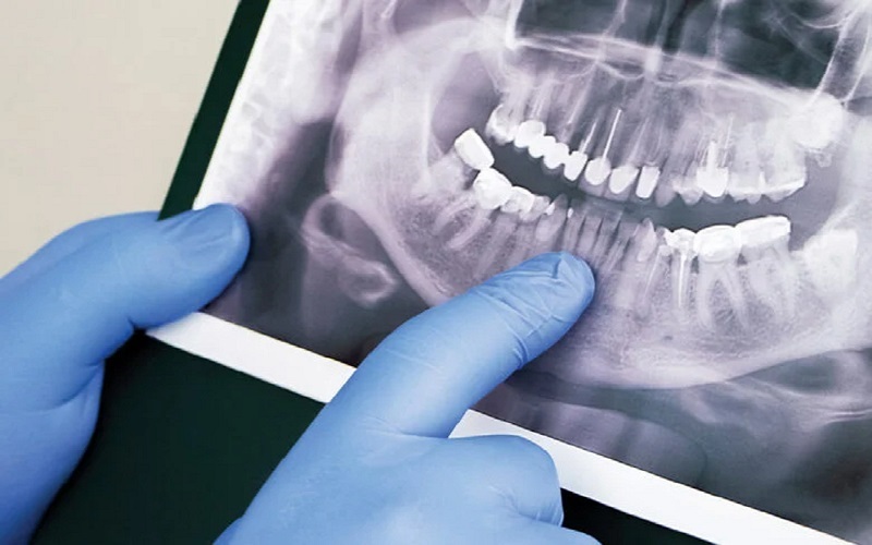 خطرات عکس Opg دندان